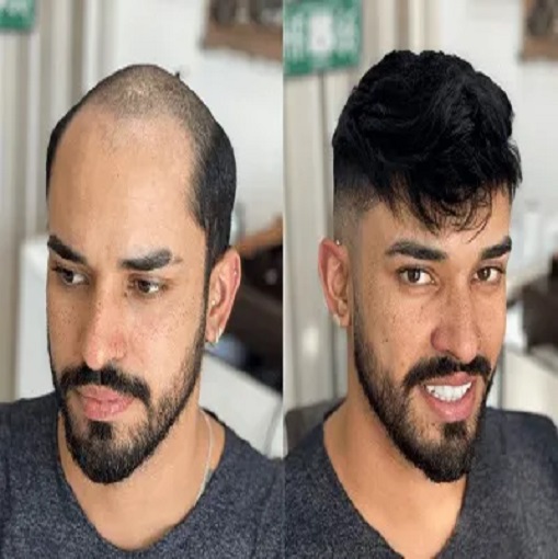 AK Hair Wig Non Surgical Hair Replacement Centre Alipore Kolkata