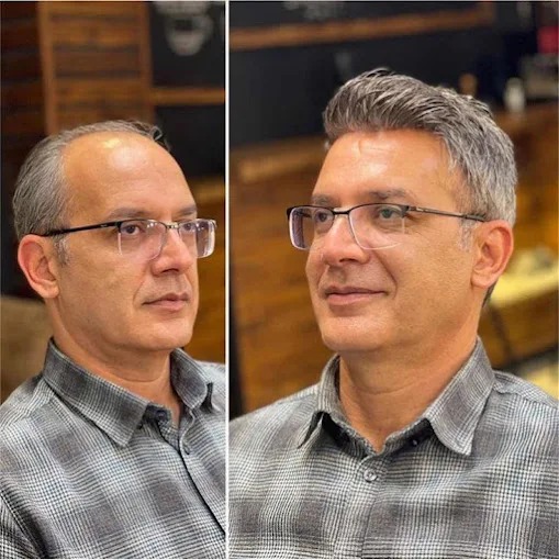 Hair Patch in Kolkata Before After Result – AK Hair Wig