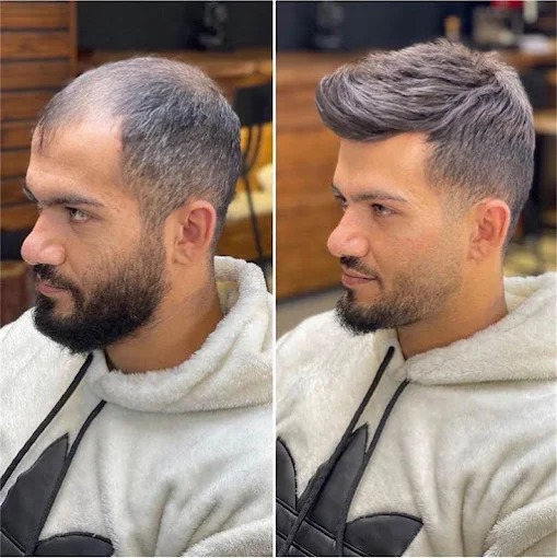 Hair Patch in Kolkata Before After Result – AK Hair Wig