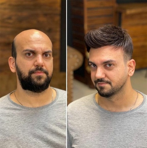 Hair Patch in Kolkata Before After Result – AK Hair Wig