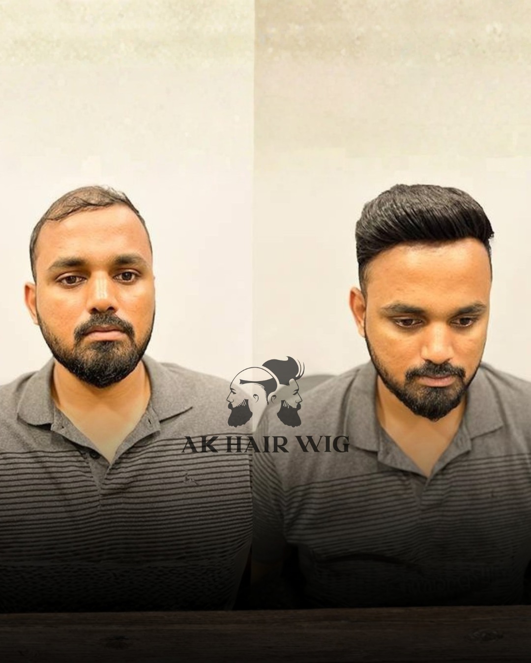 Non-Surgical Hair Replacement Service in Kolkata- Howrah-AK Hair Wig