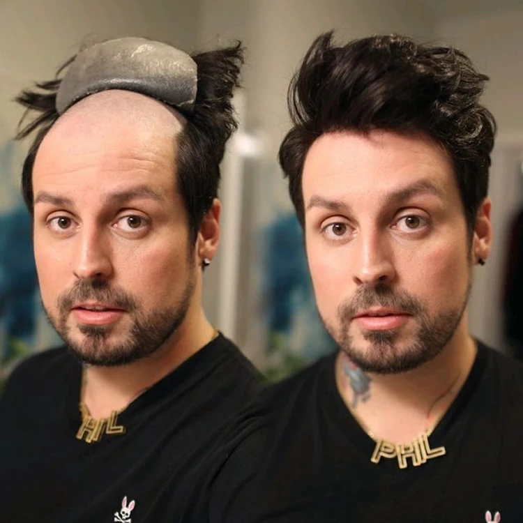Before & After - Hair Patch vs Hair Wig: Which is Right for You?